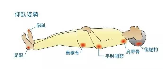 壓瘡易發(fā)部位 壓瘡易發(fā)部位