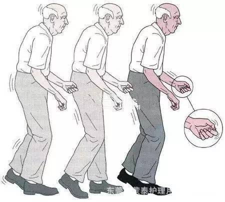 【世界帕金森病日專題】-帕金森病的危險因素 【世界帕金森病日專題】-帕金森病的危險因素